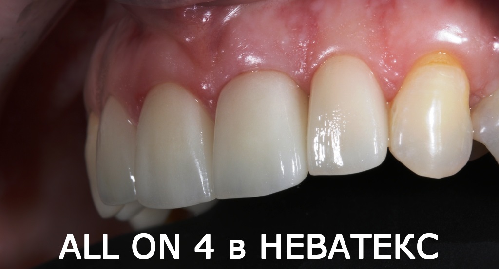 Установка всех зубов за один день в клинике в Москве зубы за один день москва